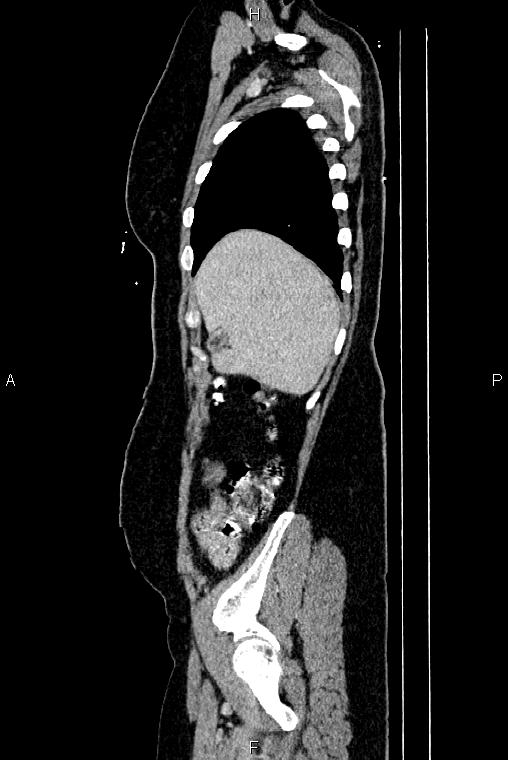 Carcinoma of uterine cervix (Radiopaedia 85861-101700 D 9).jpg