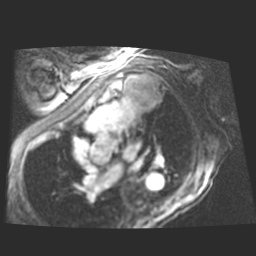 File:Cardiac fibroma (Radiopaedia 38974-41150 4 chamber FGRET 12).jpg