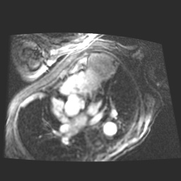 File:Cardiac fibroma (Radiopaedia 38974-41150 4 chamber FGRET 9).jpg