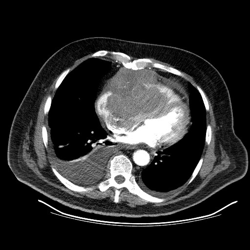 File:Cardiac lymphoma (Radiopaedia 38690-40836 Axial C+ CTPA 13).jpg