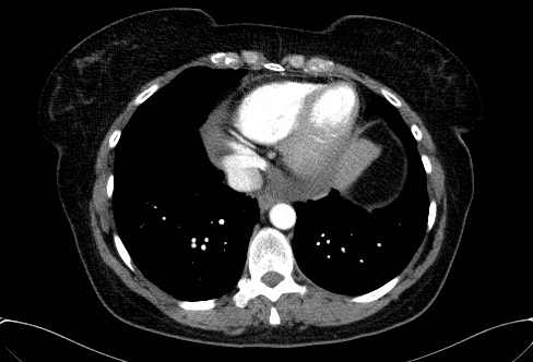 Cardiac sarcoidosis (Radiopaedia 74548-85534 A 66).jpg