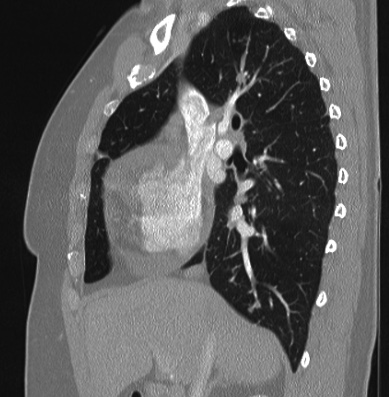 Cardiac sarcoidosis (Radiopaedia 74548-85534 Sagittal lung window 58).jpg