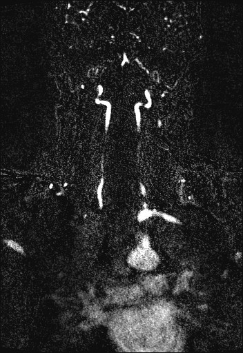 Carotid artery dissection (Radiopaedia 28441-28689 Coronal MRA 56).jpg