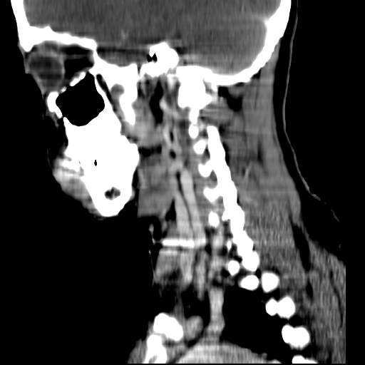 File:Carotid body tumor (Radiopaedia 27890-28124 C 6).jpg
