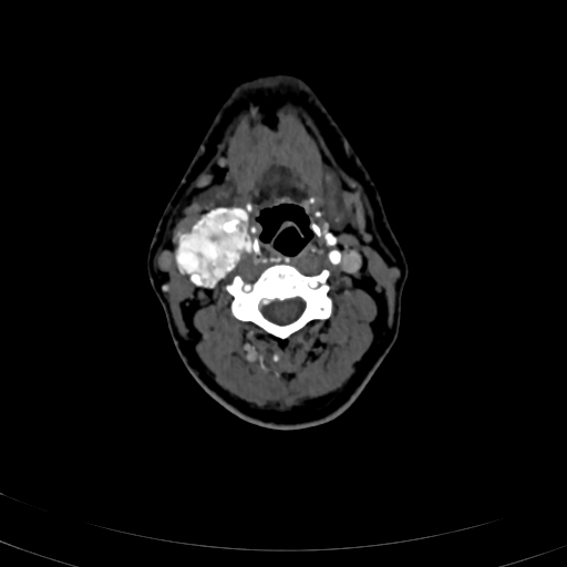 File:Carotid body tumor (Radiopaedia 83615-98727 A 57).jpg