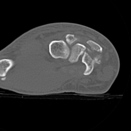 File:Carpo-metacarpal fracture-dislocations with hamatum split fracture (Radiopaedia 18482-18343 Axial bone window 16).jpg
