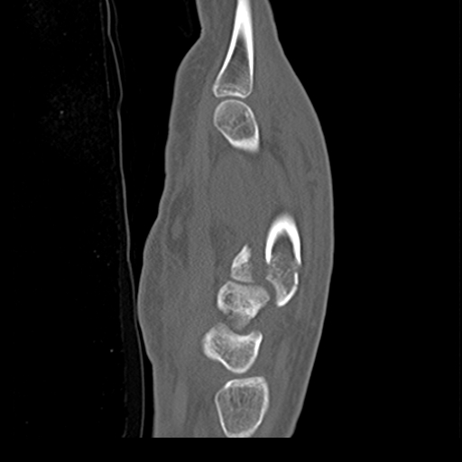 File:Carpo-metacarpal fracture-dislocations with hamatum split fracture (Radiopaedia 18482-18343 Sagittal bone window 17).jpg