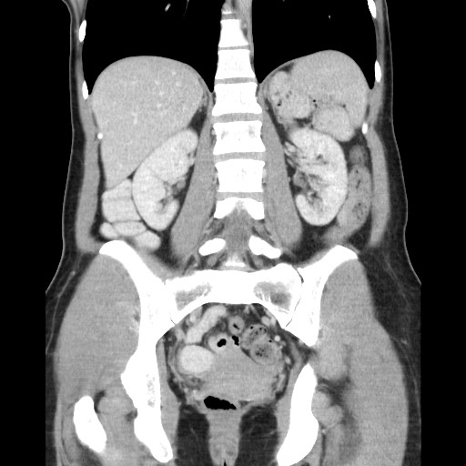 Castleman disease with fibrous pseudotumor in the abdomen (Radiopaedia 77296-89373 B 62).jpg