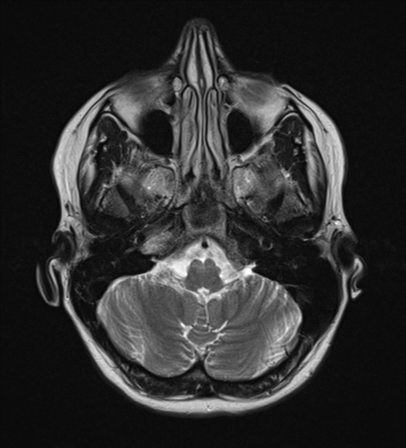 File:Cavernoma with bleed - midbrain (Radiopaedia 54546-60774 Axial T2 5).png