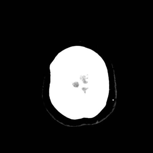 Cavernoma with hemorrhage (Radiopaedia 70755-80931 Axial non-contrast 49).png