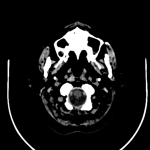 Cavernous hemangioma of the cerebellar falx (Radiopaedia 73025-83723 Axial non-contrast 4).jpg