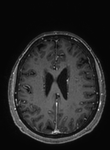 Cavernous hemangioma of the cerebellar falx (Radiopaedia 73025-83724 Axial T1 C+ 114).jpg