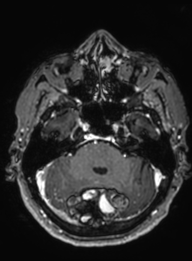 Cavernous hemangioma of the cerebellar falx (Radiopaedia 73025-83724 Axial T1 C+ 247).jpg