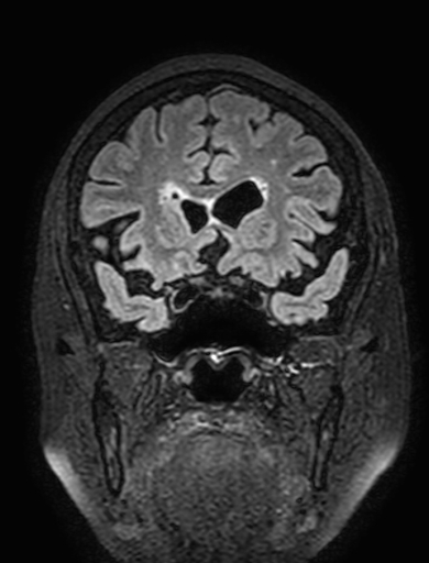 Cavernous hemangioma of the cerebellar falx (Radiopaedia 73025-83724 Coronal FLAIR 111).jpg