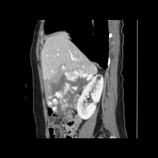 Cavernous hepatic hemangioma (Radiopaedia 75441-86667 D 61).jpg