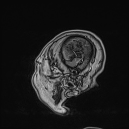 Cavernous sinus meningioma (Radiopaedia 63682-72367 Sagittal T1 C+ 155).jpg