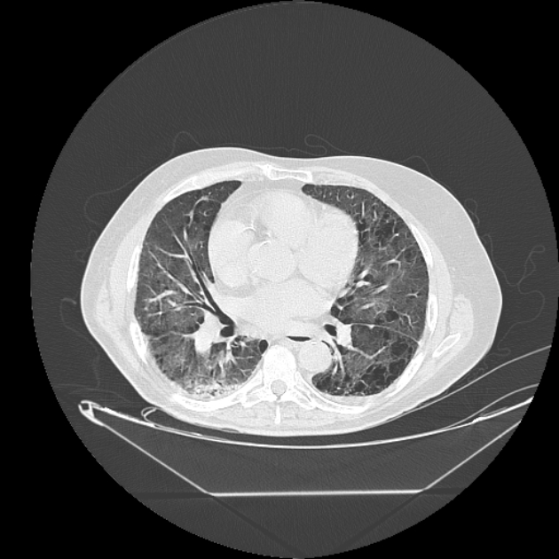 Cavitating bronchogenic carcinoma (Radiopaedia 44489-48162 Axial lung window 48).jpg