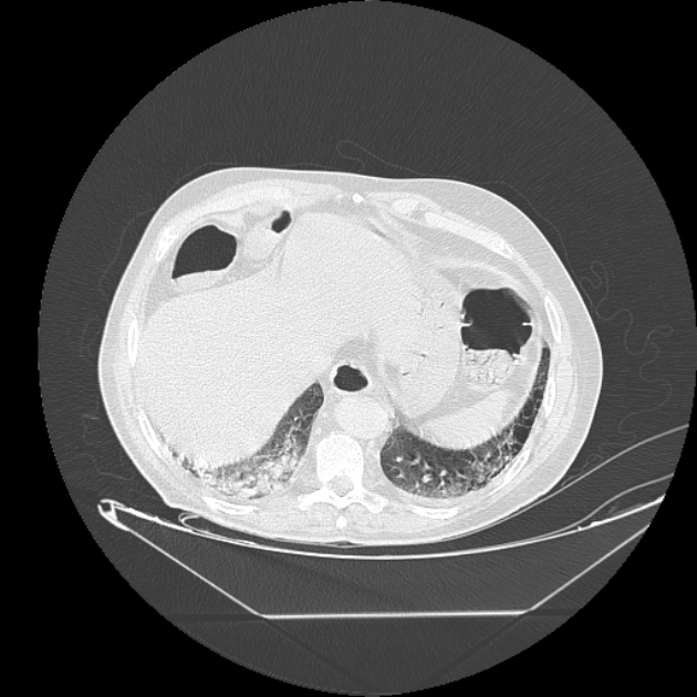 Cavitating bronchogenic carcinoma (Radiopaedia 44489-48162 Axial lung window 72).jpg