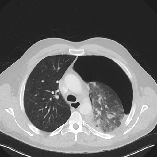 Cavitating pneumonia complicated by pneumothorax (Radiopaedia 48149-52994 Axial lung window 24).png