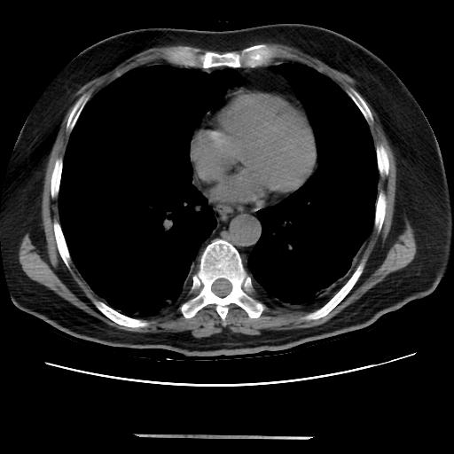 Cavitating pulmonary metastases (Radiopaedia 89545-106544 Axial non-contrast 36).jpg