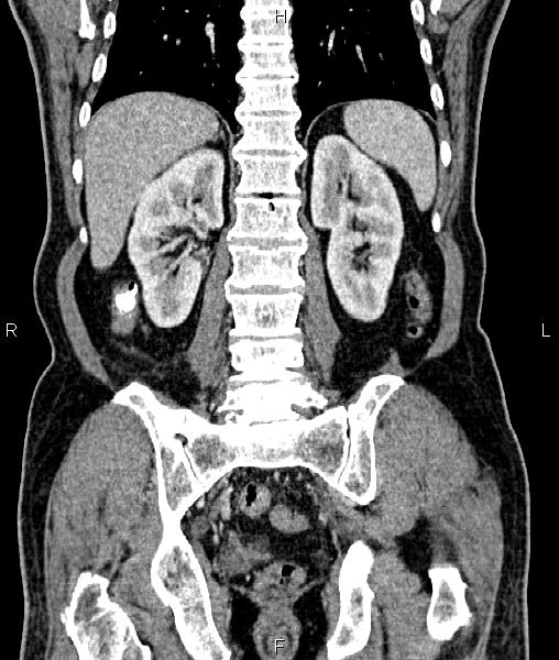 File:Cecal cancer with appendiceal mucocele (Radiopaedia 91080-108651 D 53).jpg