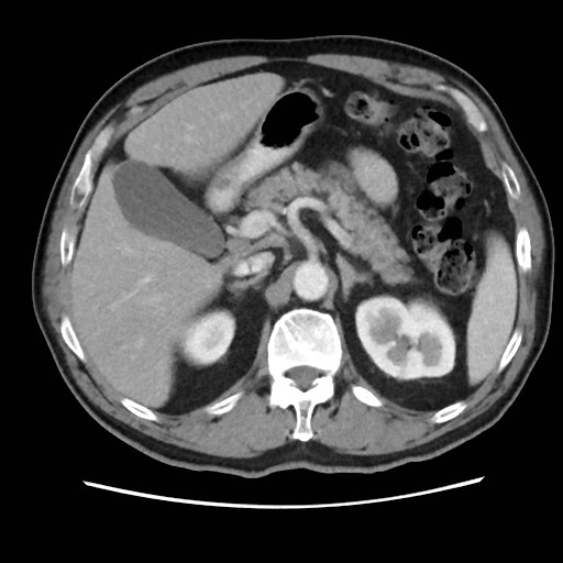 File:Cecal mass causing appendicitis (Radiopaedia 59207-66531 A 27).jpg