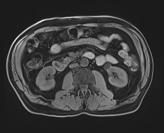 Cecal mass causing appendicitis (Radiopaedia 59207-66532 Axial T1 66).jpg