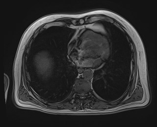 Cecal mass causing appendicitis (Radiopaedia 59207-66532 D 12).jpg