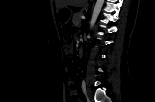 Celiac artery compression syndrome (Radiopaedia 47538-52152 B 59).jpg