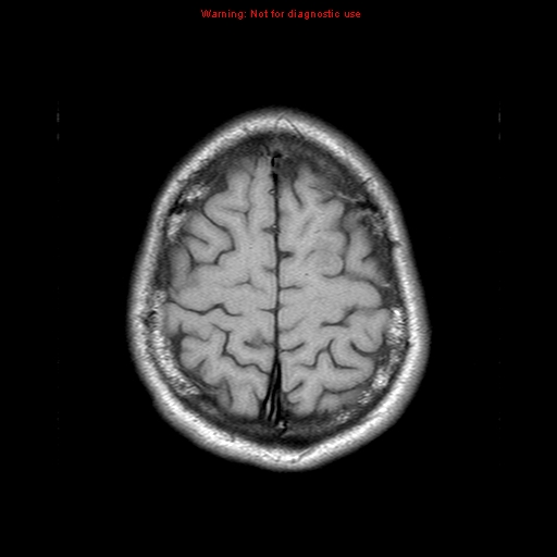 File:Central nervous system vasculitis (Radiopaedia 8410-9235 Axial T1 21).jpg