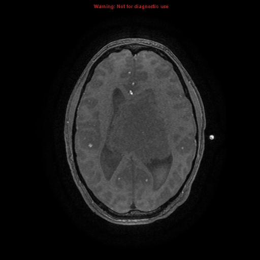 Central neurocytoma (Radiopaedia 13188-13206 Axial MRA 17).jpg