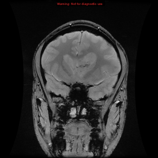 File:Central neurocytoma (Radiopaedia 13188-13206 G 12).jpg
