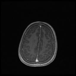 Central neurocytoma (Radiopaedia 30220-30842 Axial T1 C+ 122).jpg