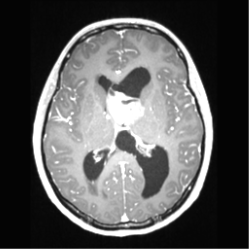 Central neurocytoma (Radiopaedia 37664-39557 Axial T1 C+ 43).png