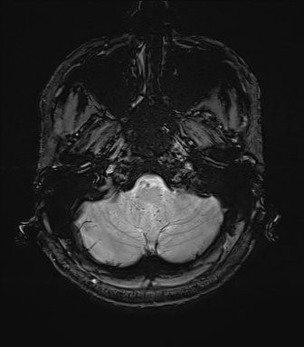 Central neurocytoma (Radiopaedia 71068-81303 Axial SWI 3).jpg
