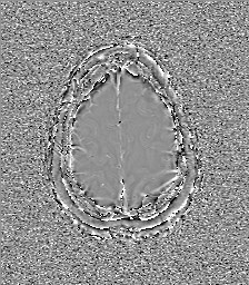 Central neurocytoma (Radiopaedia 84497-99872 Axial 62).jpg