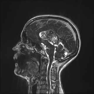 Central neurocytoma (Radiopaedia 84497-99872 Sagittal CISS 41).jpg