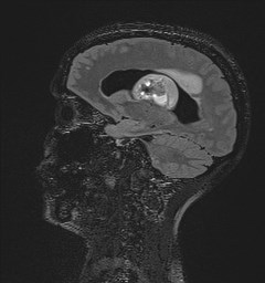 File:Central neurocytoma (Radiopaedia 84497-99872 Sagittal Flair + Gd 61).jpg