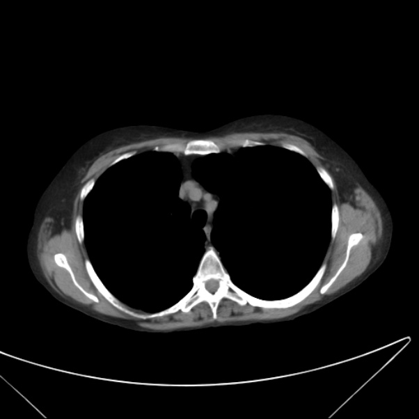 Centrilobular pulmonary emphysema (Radiopaedia 24495-24789 Axial non-contrast 14).jpg