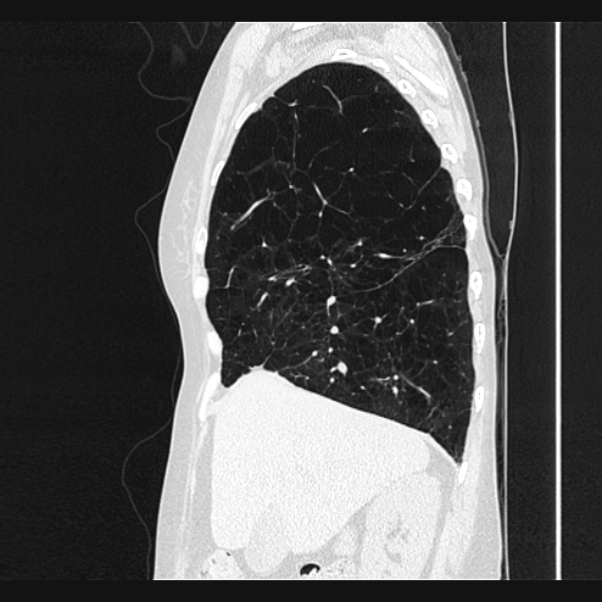Centrilobular pulmonary emphysema (Radiopaedia 24495-24789 Sagittal lung window 22).jpg