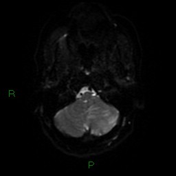 Cerebellar abscess (Radiopaedia 78135-90678 Axial DWI 35).jpg