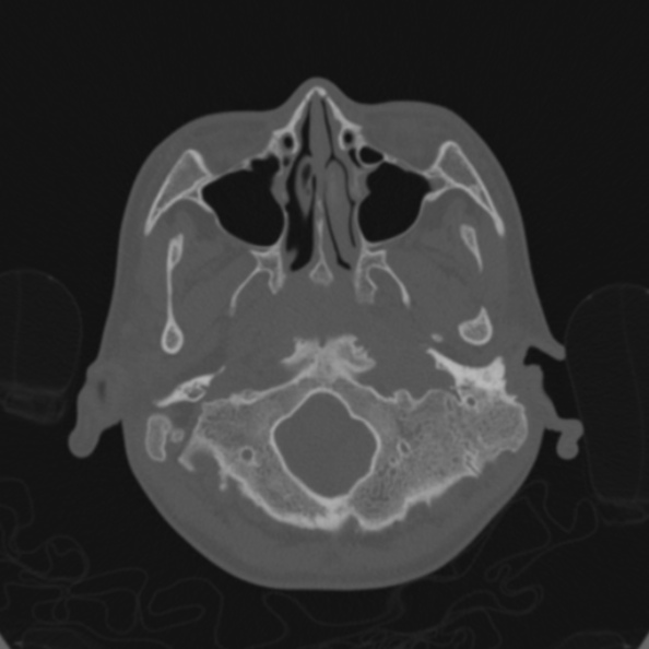 Cerebellar abscess secondary to mastoiditis (Radiopaedia 26284-26413 Axial bone window 23).jpg