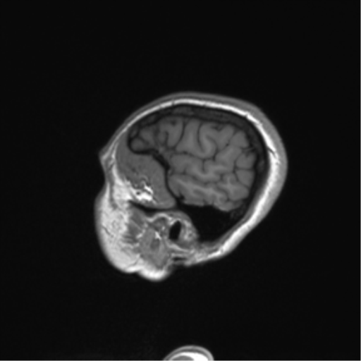 Cerebellar agenesis with hypoplastic pons (pontocerebellar hypoplasia) (Radiopaedia 57224-64138 Sagittal T1 57).png