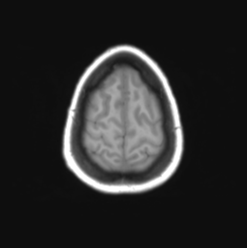 File:Cerebellar ependymoma complicated by post-operative subdural hematoma (Radiopaedia 83322-97736 Axial T1 35).png