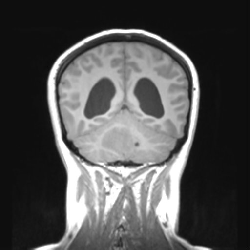 Cerebellar ependymoma complicated by post-operative subdural hematoma (Radiopaedia 83322-97736 Coronal T1 41).png