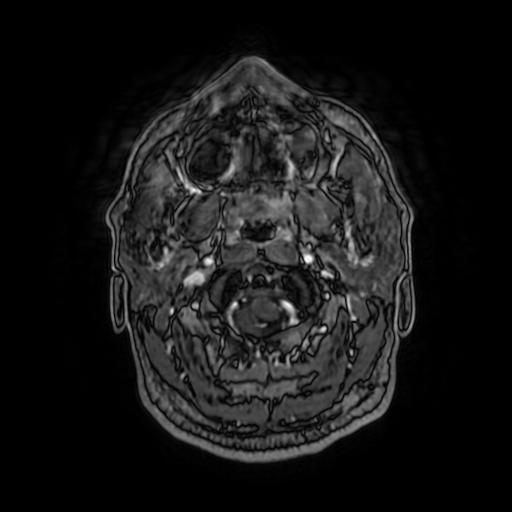 Cerebellar hemangioblastoma (Radiopaedia 88055-104622 Axial T1 C+ 24).jpg