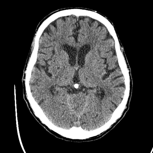 Cerebellar hemorrhage (Radiopaedia 27193-27359 Axial non-contrast 24).jpg