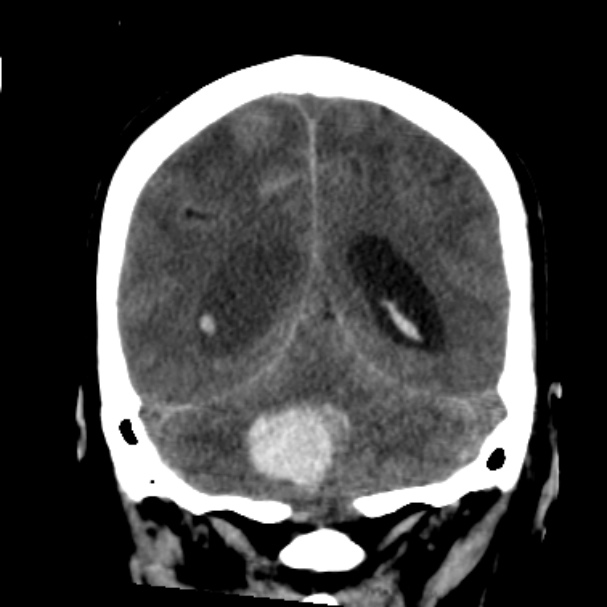 Cerebellar hemorrhage causing obstructive hydrocephalus (Radiopaedia 33989-35207 Coronal non-contrast 39).jpg