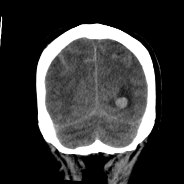 Cerebellar hemorrhage causing obstructive hydrocephalus (Radiopaedia 33989-35207 Coronal non-contrast 44).jpg