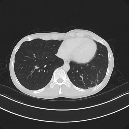Cerebellar metastasis - adenocarcinoma lung (Radiopaedia 63184-71717 Axial lung window 50).png